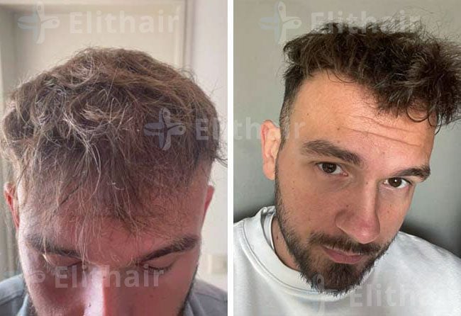 نتائج زراعة الشعر في مركز اليت هير 4500 بصيلة