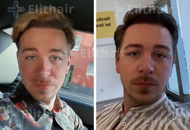 نتائج زراعة الشعر للسد توبايس