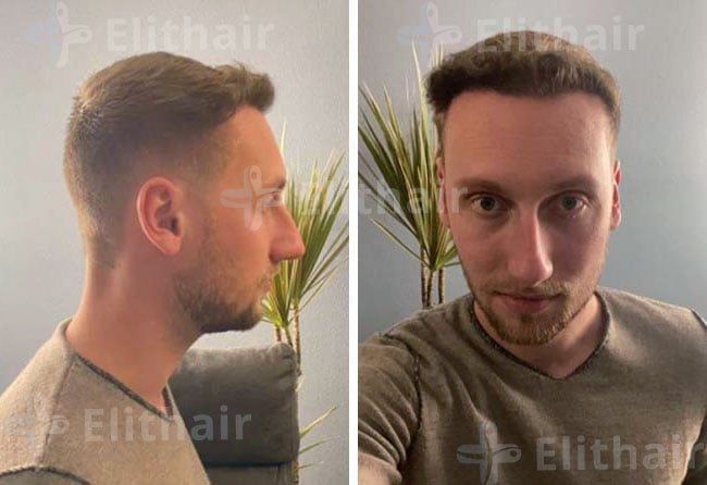 نتائج زراعة الشعر للسيد أوليفر 3950 بصيلة
