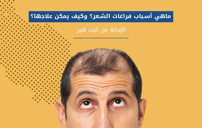 تجارب زراعة الشعر في مشفى اليت هير