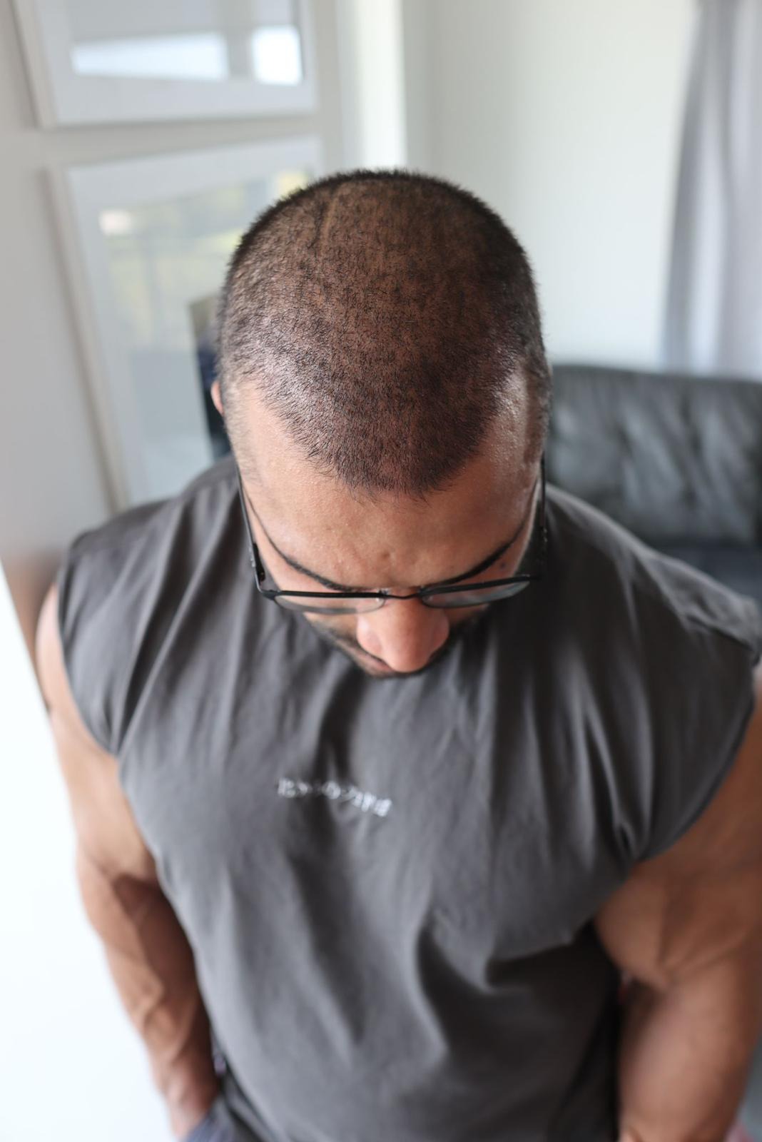 بعد 9 أشهر من زراعة الشعر في مشفى اليت هير