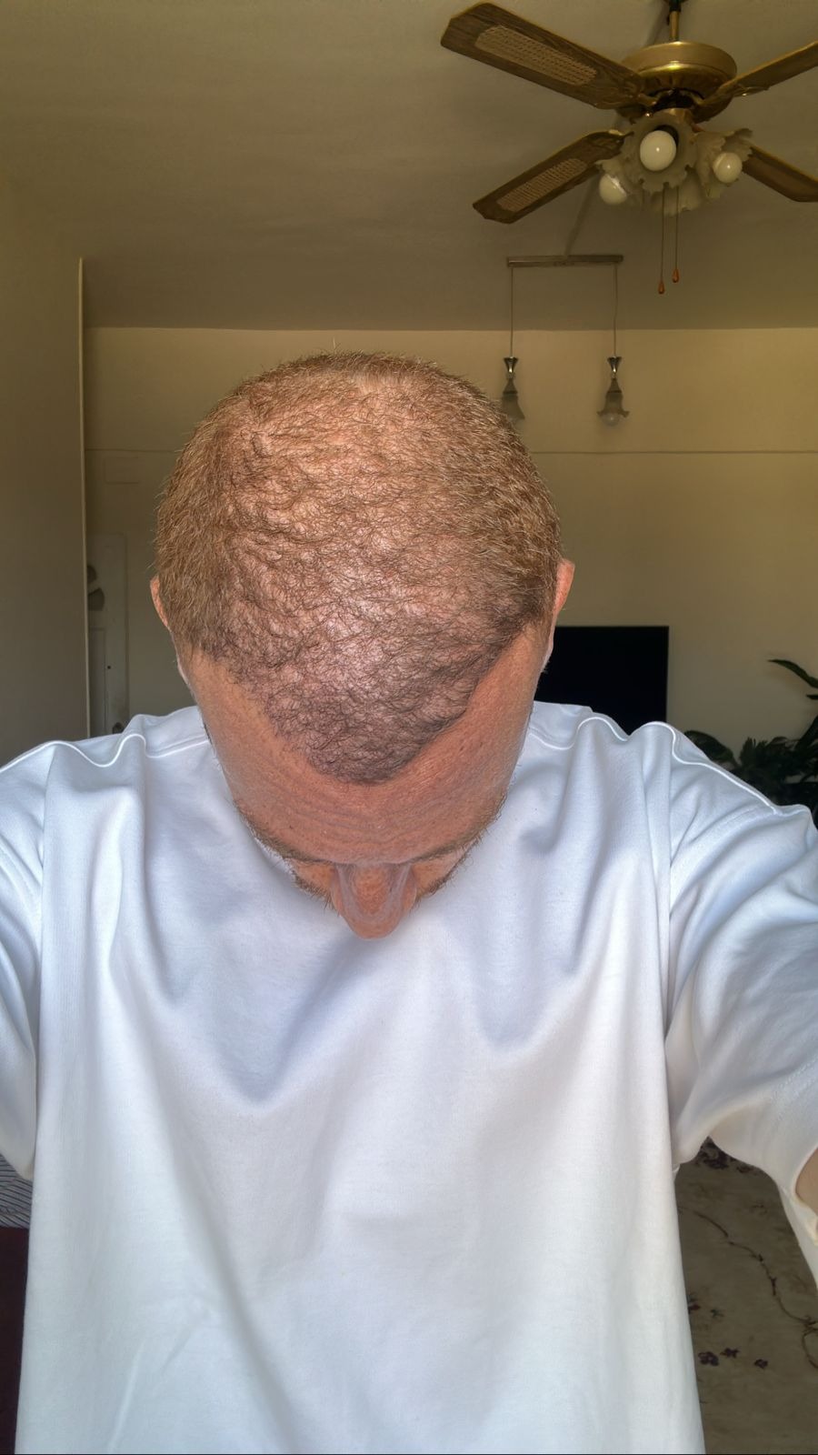 نتائج زراعة الشعر بعد 6 اشهر في مشفى اليت هير