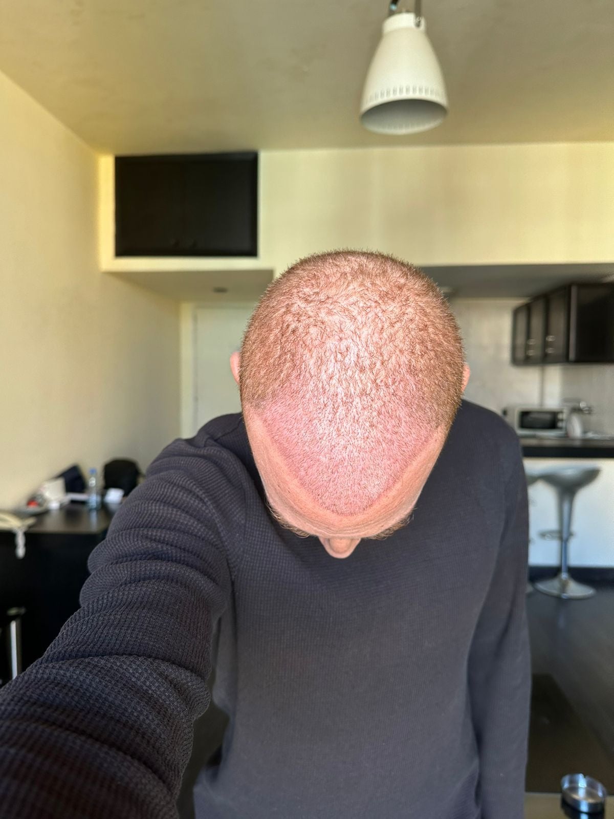 بعد أسبوع من زراعة الشعر في مشفى اليت هير