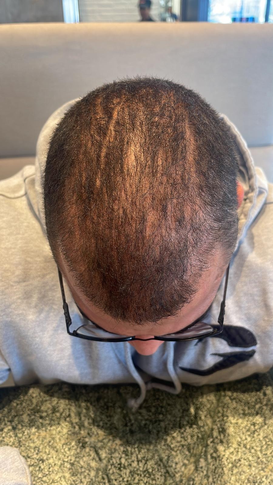 بعد شهرين من زراعة الشعر في مشفى اليت هير