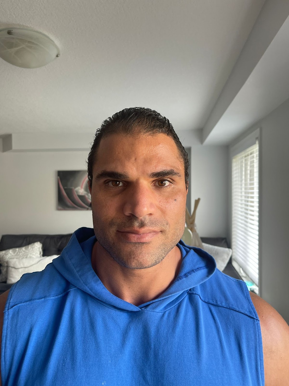 بعد عام من زراعة الشعر في مشفى اليت هير