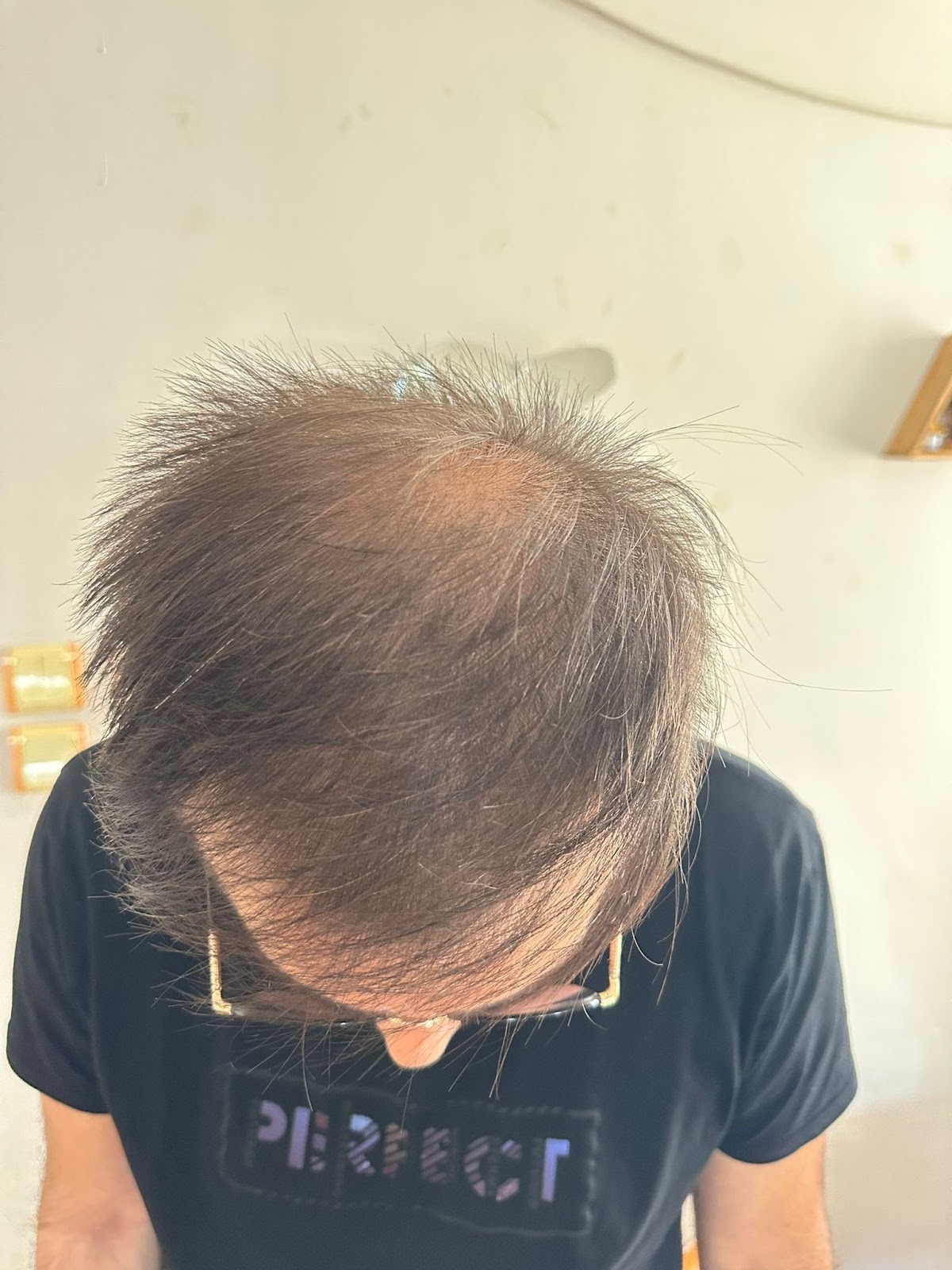 ما قبل زراعة الشعر في مشفى اليت هير