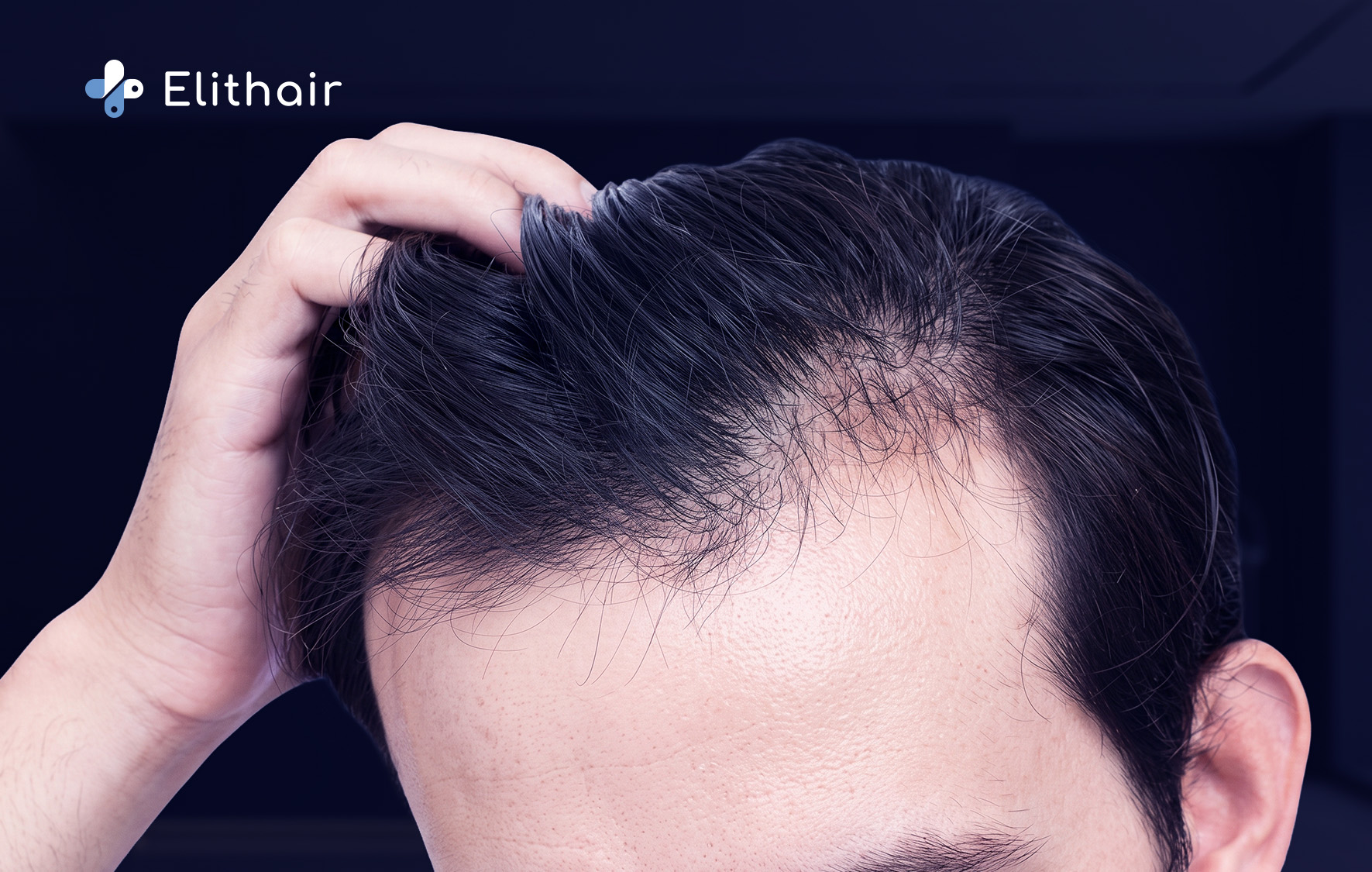 تكثيف الشعر في مقدمة الرأس - مركز اليت هير لزراعة الشعر