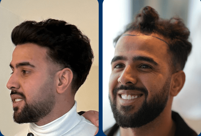 زراعة الشعر للسيد موسى - مشفى اليت هير