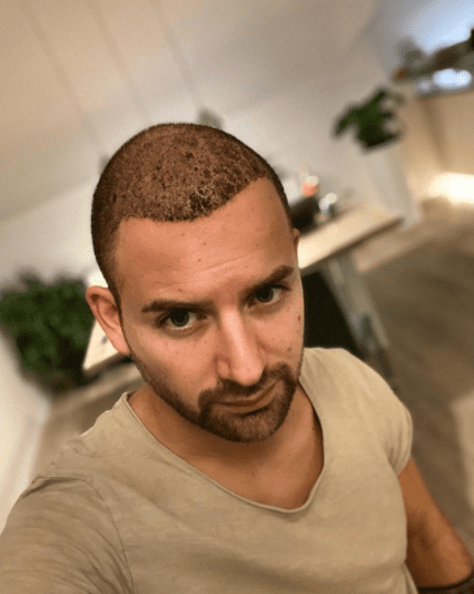 مراحل نمو الشعر المزروع بالصور بعد شهر من زراعة الشعر 