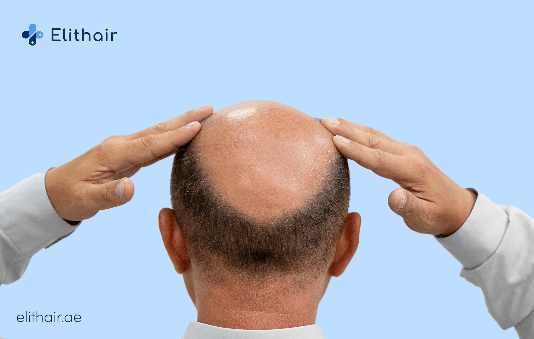 عيادات زراعة الشعر في دبي