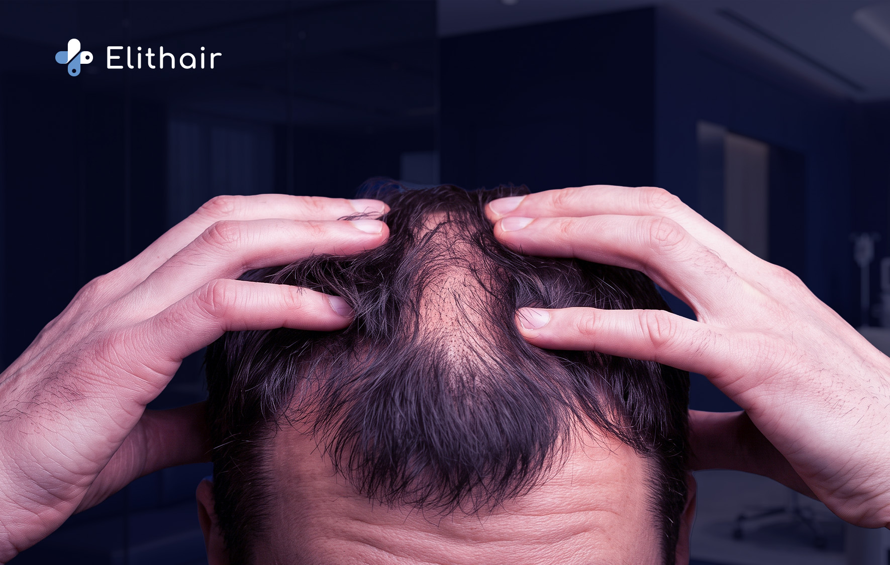 تساقط الشعر الكربي - مركز اليت هير لزراعة الشعر
