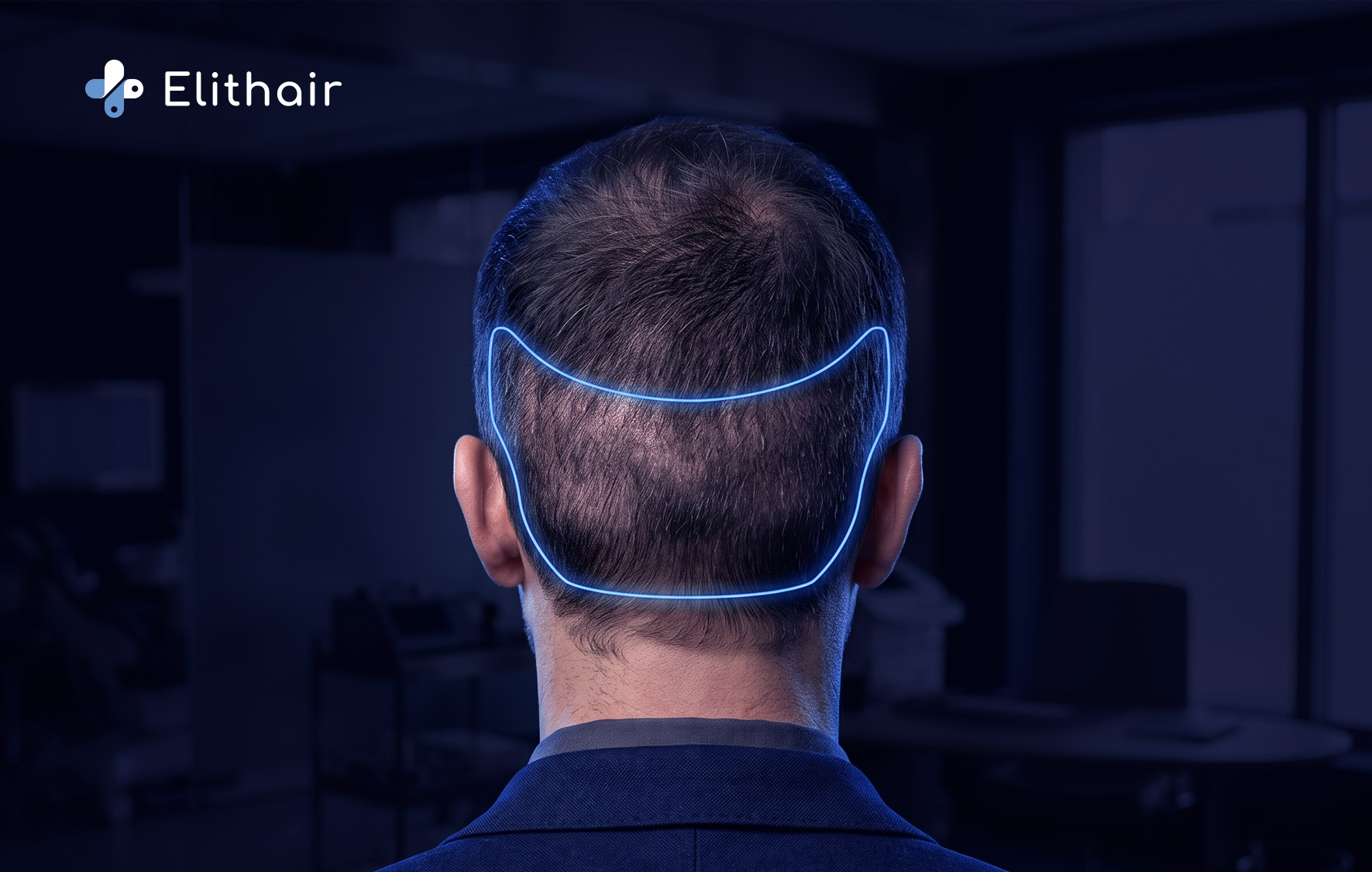 ماذا يحدث للمنطقة المانحة بعد زراعة الشعر؟