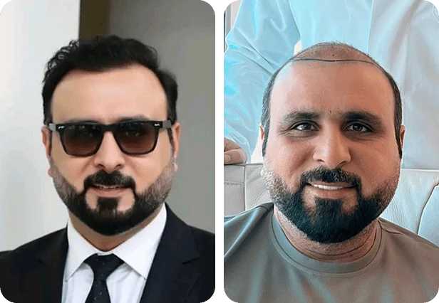 نتائج زراعة الشعر للسيد أفسار في مركز اليت هير