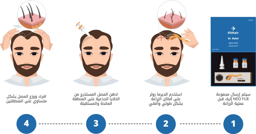 مجموعة NEO FUE  الحصرية بمركز اليت هير لزراعة الشعر