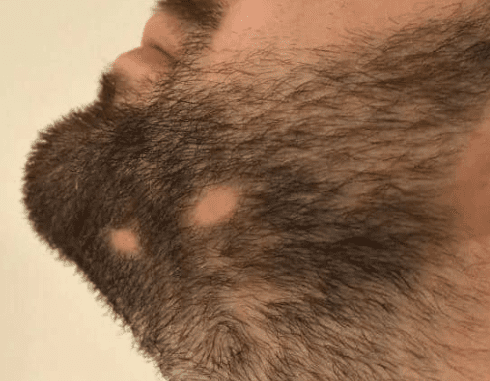 ثعلبة الذقن - مركز اليت هير لزراعة الشعر