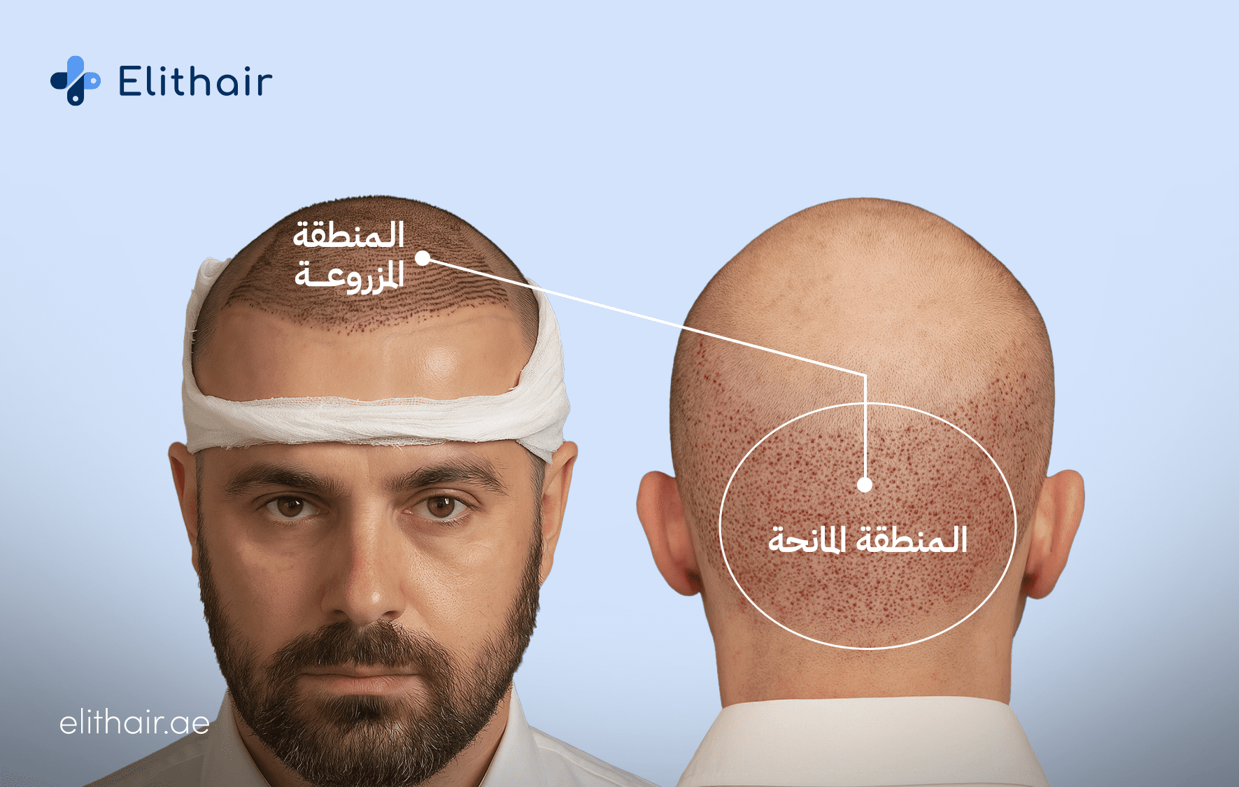 المنطقة المانحة والمزروعة - مركز اليت هير لزراعة الشعر