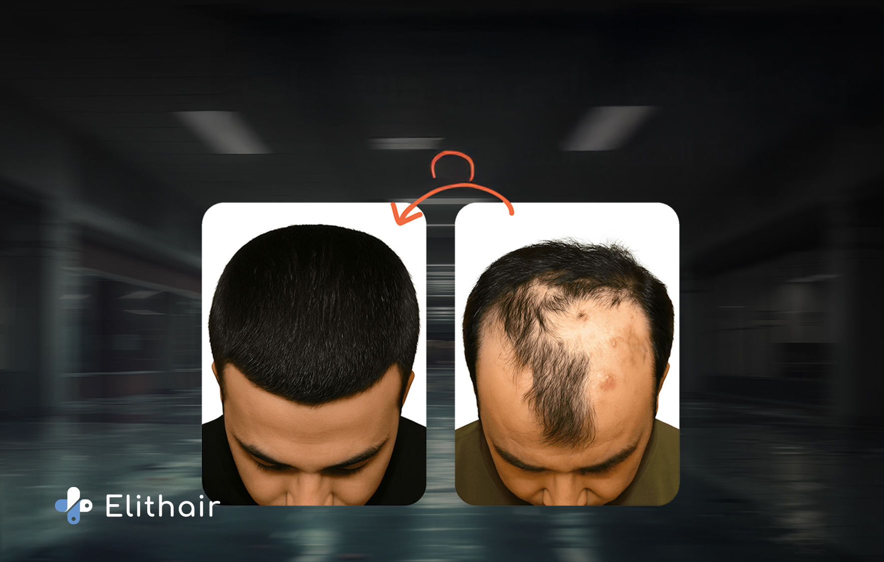 زراعة الشعر في الحروق والتدبات - مركز اليت هير لزراعة الشعر