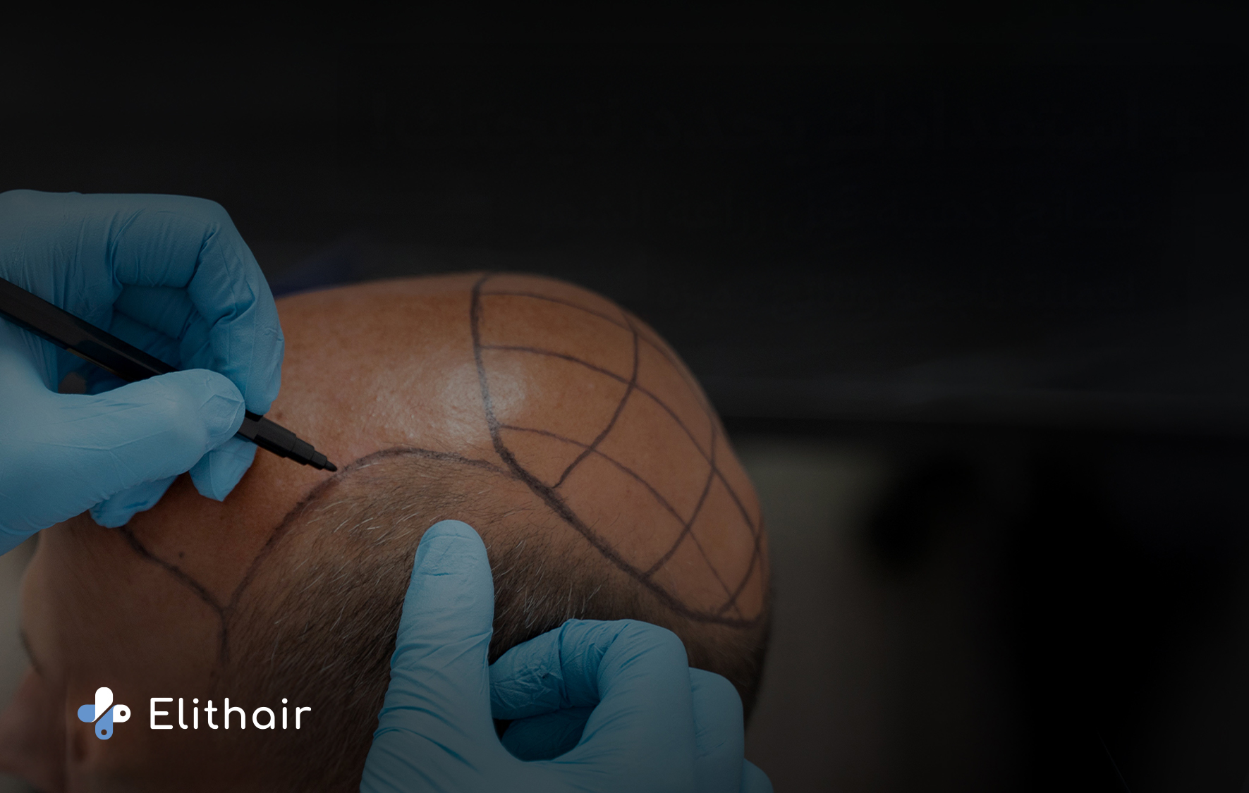 نصائح لزراعة شعر ناجحة - مركز اليت هير لزراعة الشعر