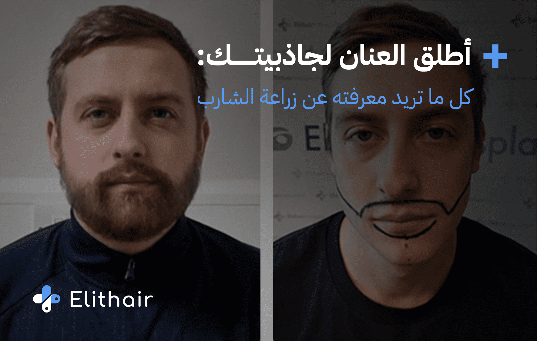 زراعة الشارب في تركيا في اليت هير
