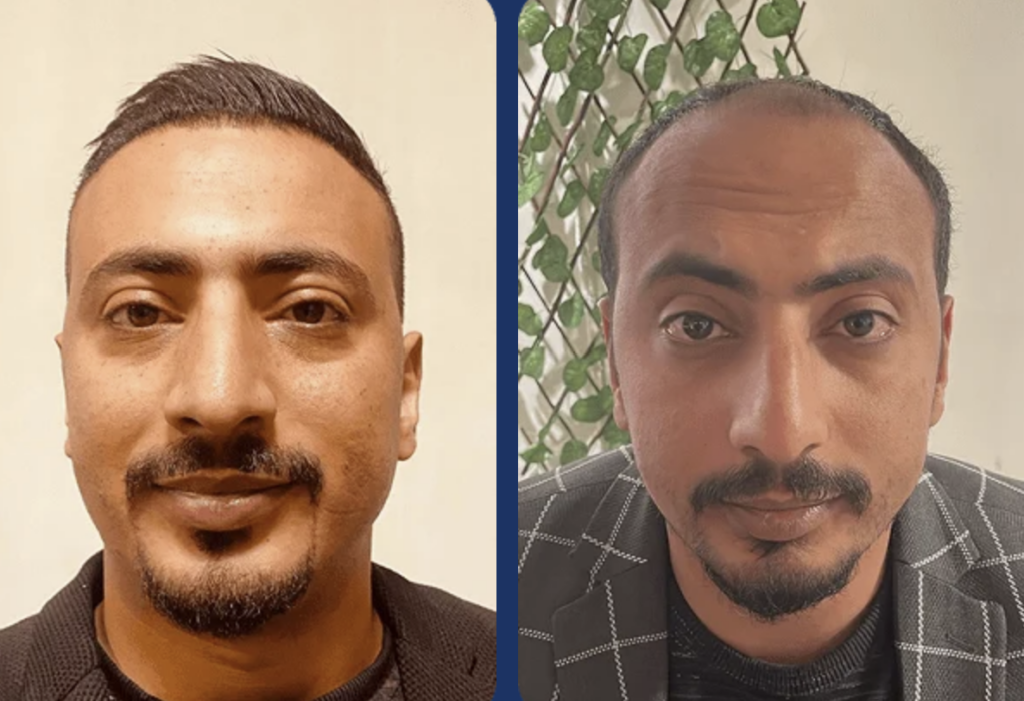 زراعة الشعر قبل وبعد للسيد محمد