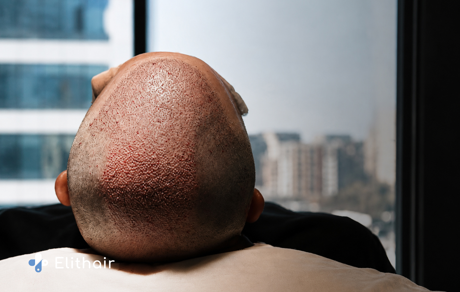 طريقة زراعة الشعر الصناعي في تركيا