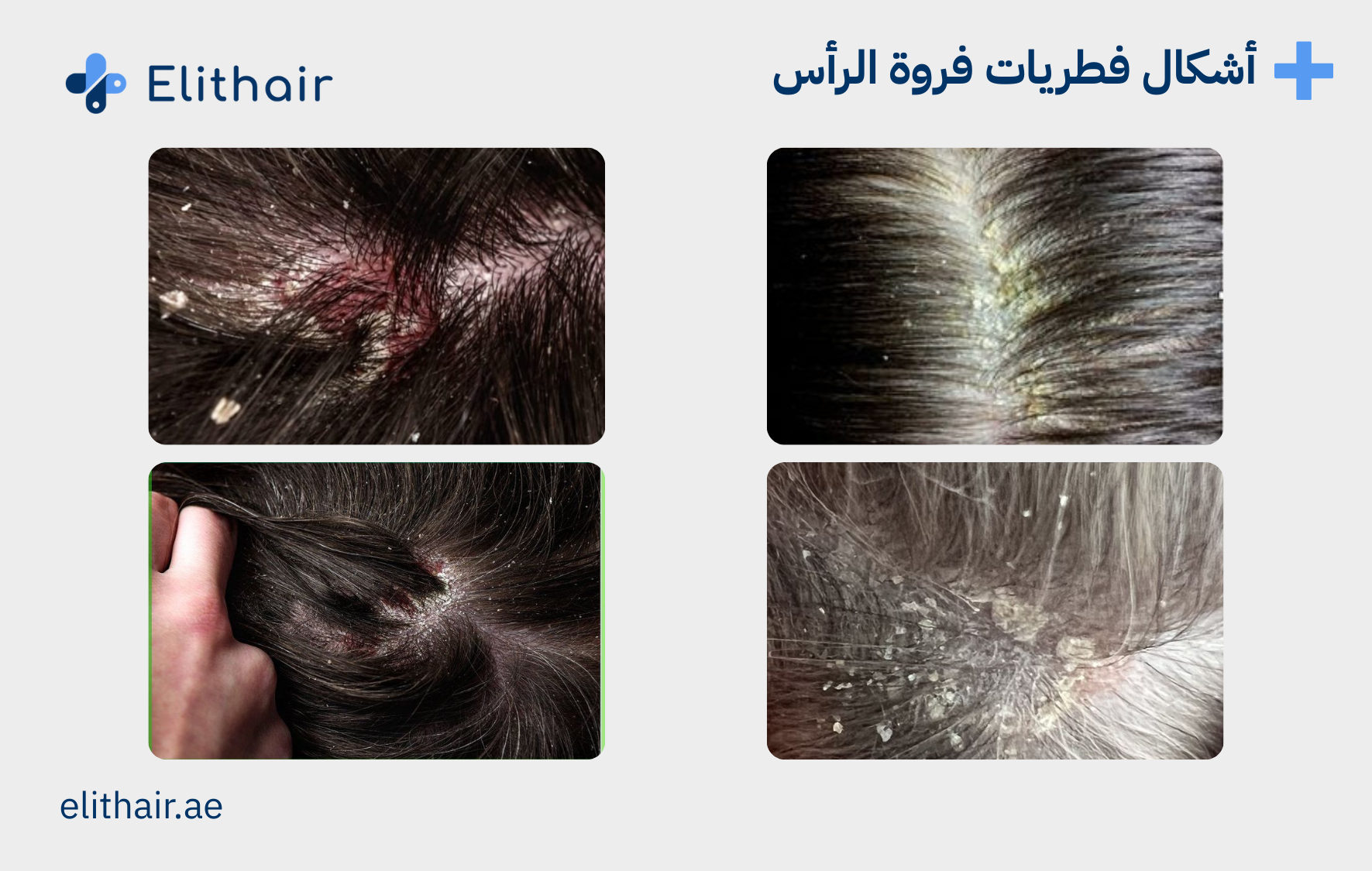 اشكال فطريات فروة الرأس - مركز اليت هير لزراعة الشعر