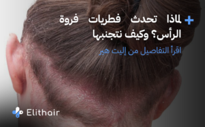 تظهر الصورة شخص مريض بفطريات فروة الرأس - مركز اليت هير لزراعة الشعر