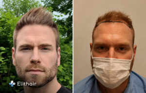 رجل قبل وبعد عملية زراعة الشعر كحل لتساقط الشعر المبكر عند الرجال