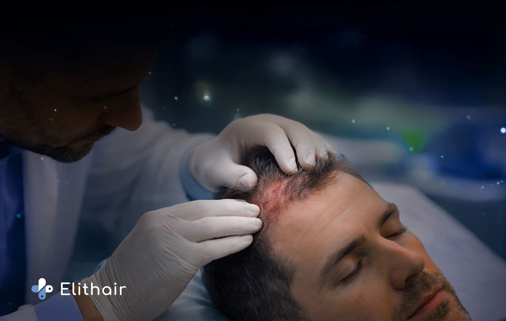 الذئبة الحمراء وعلاقتها بتساقط الشعر - مركز اليت هير لزراعة الشعر
