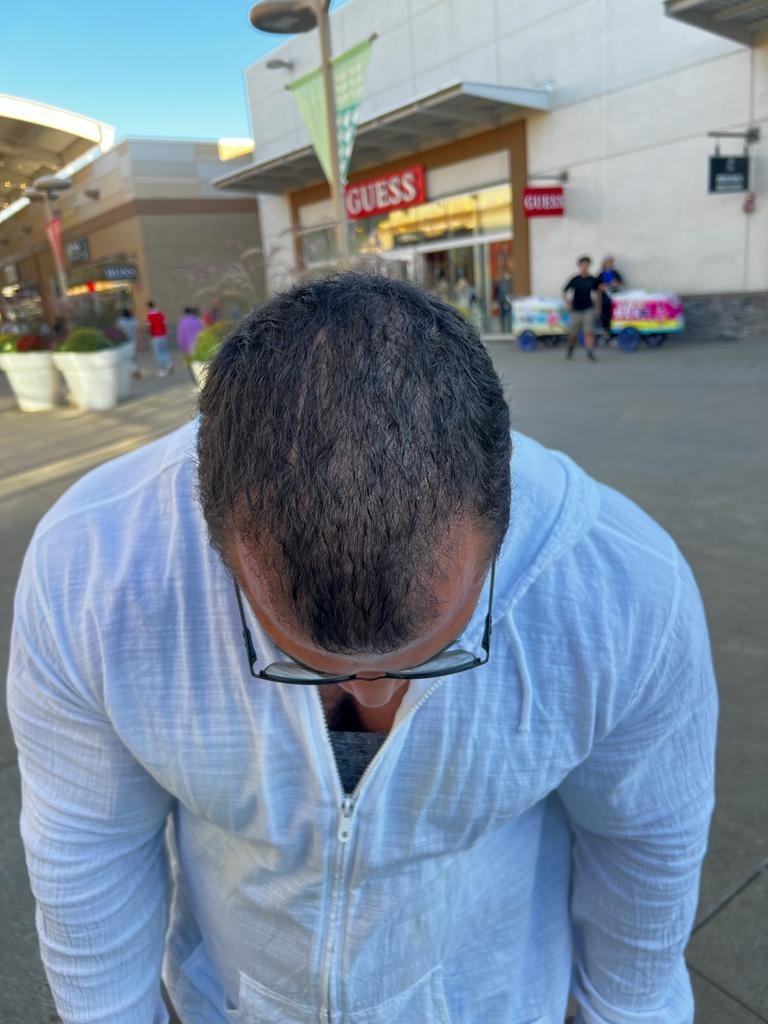 نتائج زراعة الشعر لحسن مصطفى بعد شهرين في اليت هير