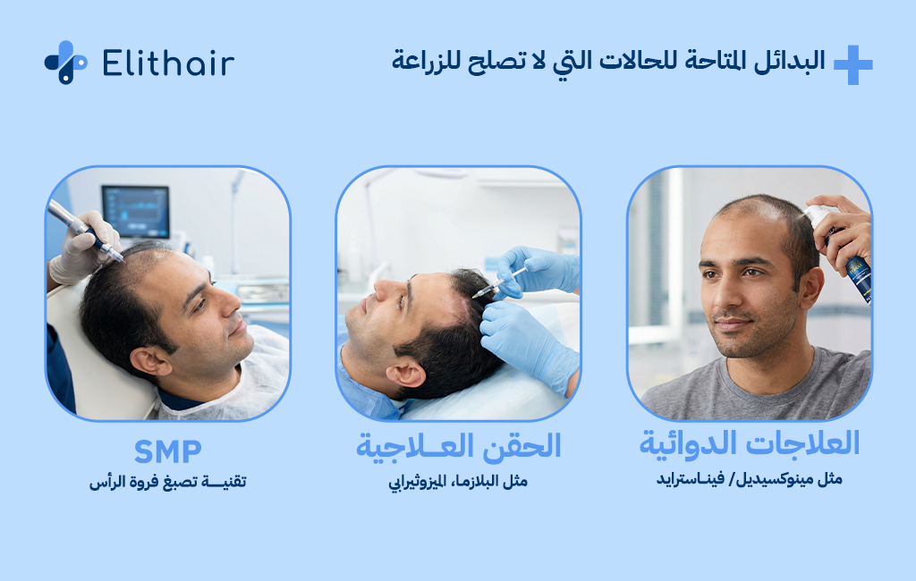 البدائل المتاحة للحالات التي لت تصلح لزراعة الشعر - مركز اليت هير لزراعة الشعر