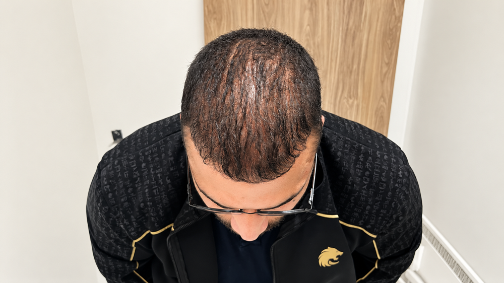 مريض زراعة شعر يظهر ترقق الشعر وانخفاض الكثافة في مقدمة وأعلى الرأس