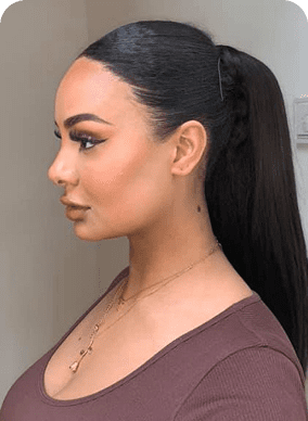 بعد سنة من زراعة الشعر، زراعة الشعر للنساء في تركيا