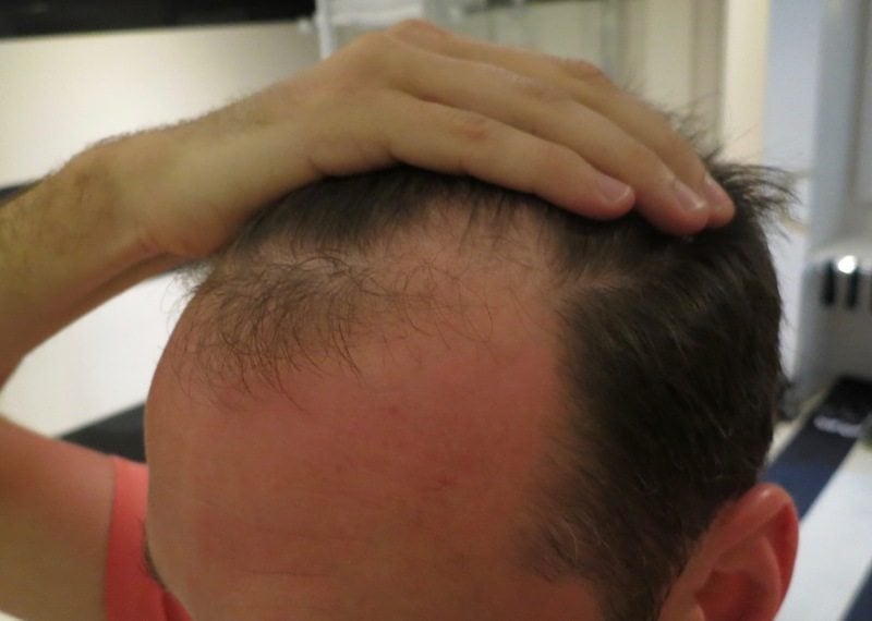 Haartransplantation Erfahrung mit Elithairtransplant