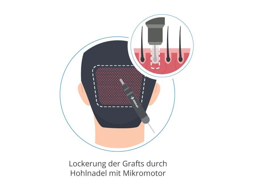 Infografik für die FUE Technik als Haartransplantation Methode