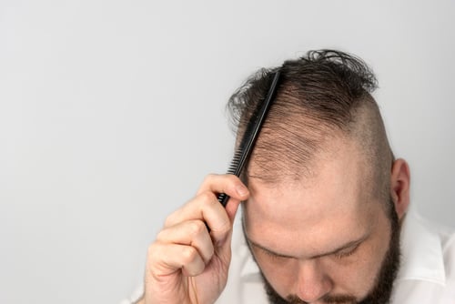 Ursachen von Haarausfall – diffuse Haarausfall bei Männer