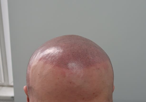 Haartransplantation Glatze