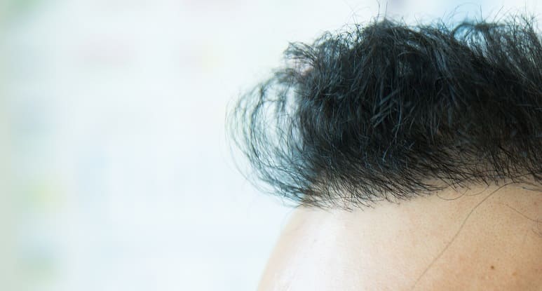 Haaransatz beim Mann - Natürliche Haarlinie nach Haartransplantation