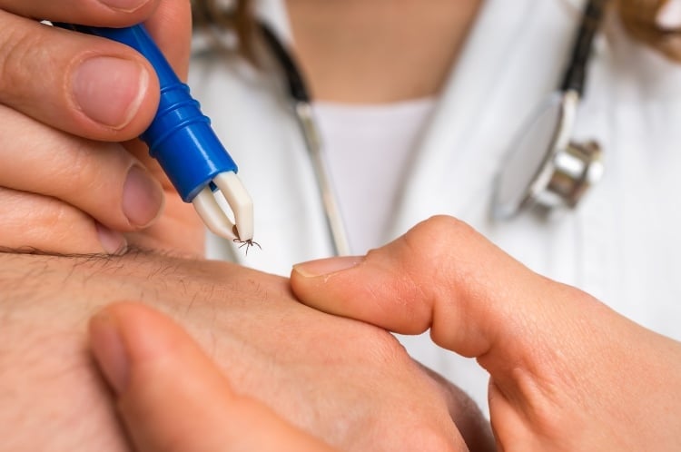 Arzt nimmt mit einer Zange eine Zecke aus der Haut eines Patienten