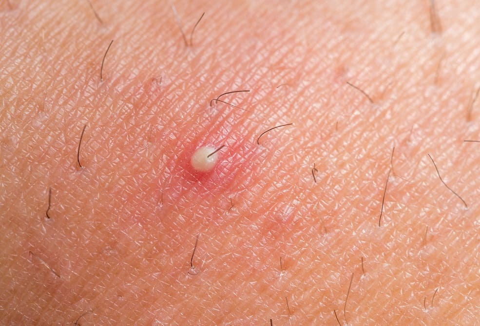 Nahaufnahme einer Haarwurzelentzündung mit Eiterbläschen