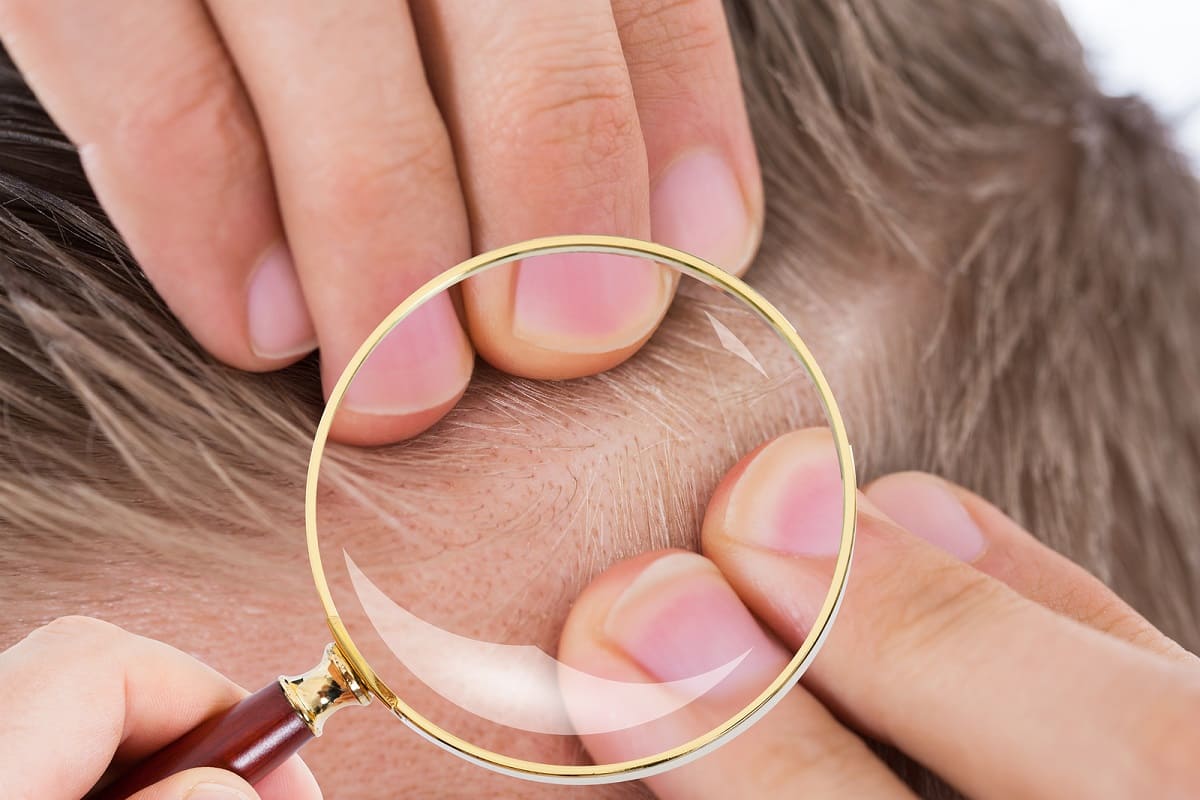 Führt eine Haarwurzelentzündung zu Haarausfall