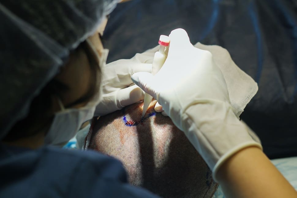 Nahaufnahme der DHI Behandlung am Hinterkopf mit Choi Implanter Stift