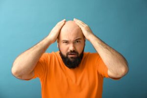 Mann mit komplettem Haarausfall bei Alopecia Totalis