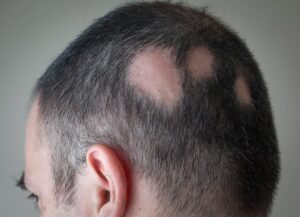 Kreisrunder Haarausfall auf Hinterkopf von Mann
