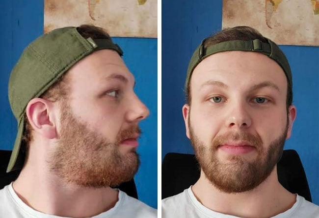 Nachher Saphir Barttransplantation mit 3250 Grafts bei Patient Sascha Lockemann