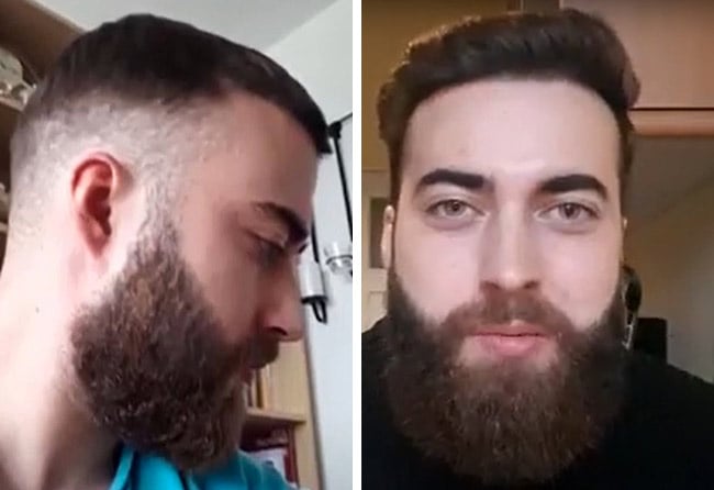 Nachher Saphir Barttransplantation mit 4250 Grafts bei Patient Andre Ulbrich