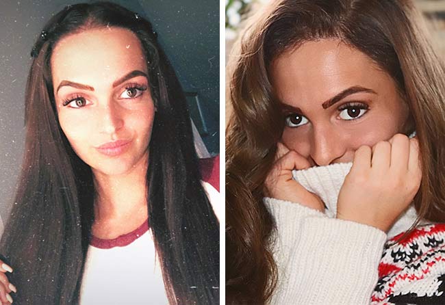 Nachher Saphir Haartransplantation mit 2200 Grafts bei Patientin Karin Baumann