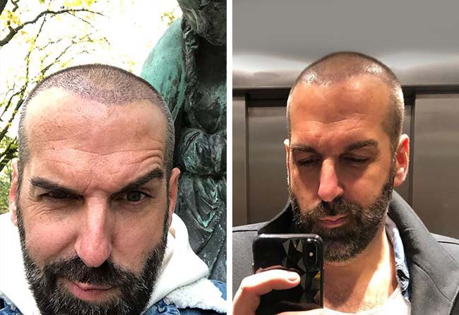 Nachher Saphir Haartransplantation mit 3400 Grafts bei Patient Jürgen T. nach 2 Monaten