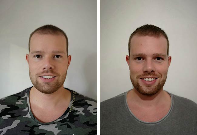 Vorher Nachher Saphir Haartransplantation mit 2800 Grafts bei Patient Alexander Kitzel nach 3 Monaten
