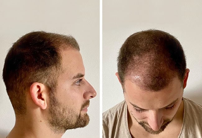 Vorher nachher Saphir Haartransplantation mit 4200 Grafts bei Patient Marcel Oliva nach 3 Monaten